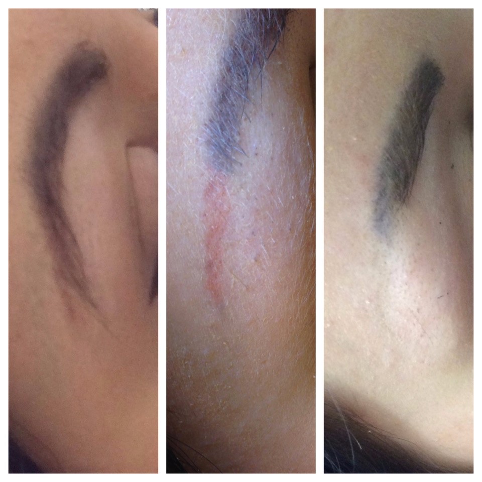 Vorher Nachher Permanent Makeup Entfernung Laserpraxis Erfurt 1.jpg