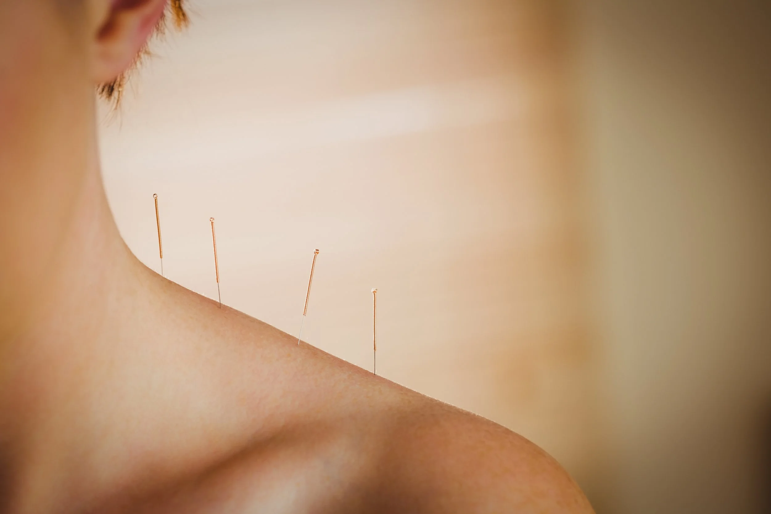 Study: Acupuncture Key in Pain Processing