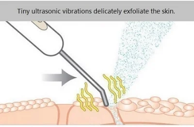  Ultrasonic Deep Cleansing  utilises ultrasonic wave motion to remove aged surface skin cells, and surface impurities such as blackheads and whiteheads. 