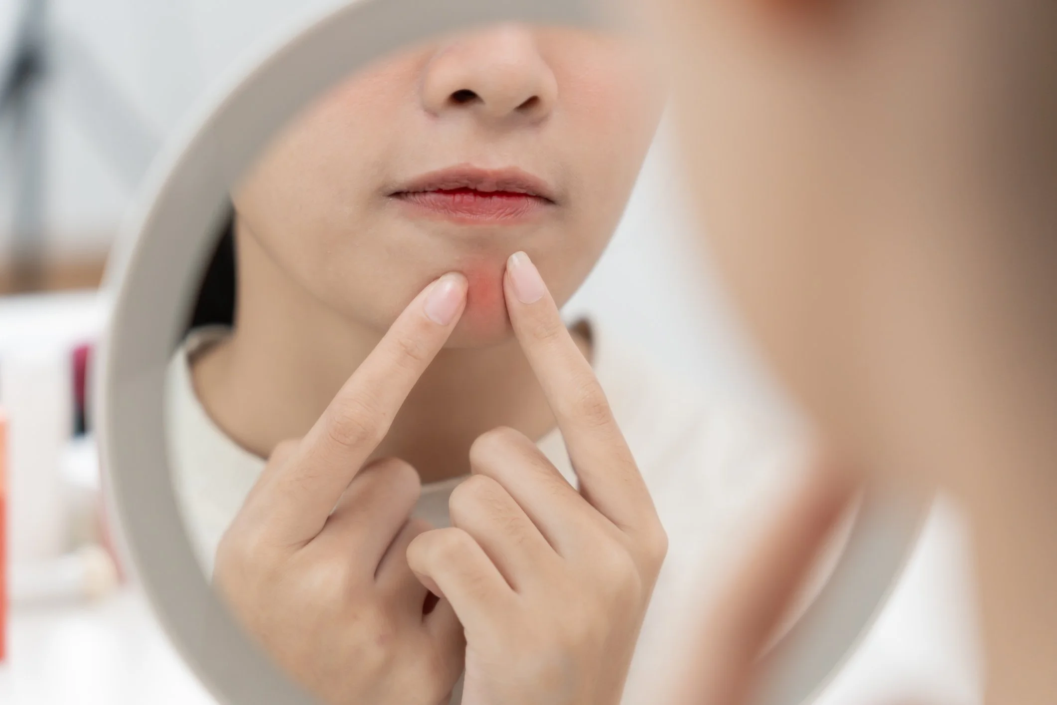 Acne Facials in Singapore: Top Treatments &amp; Ingredients for Acne-Prone Skin