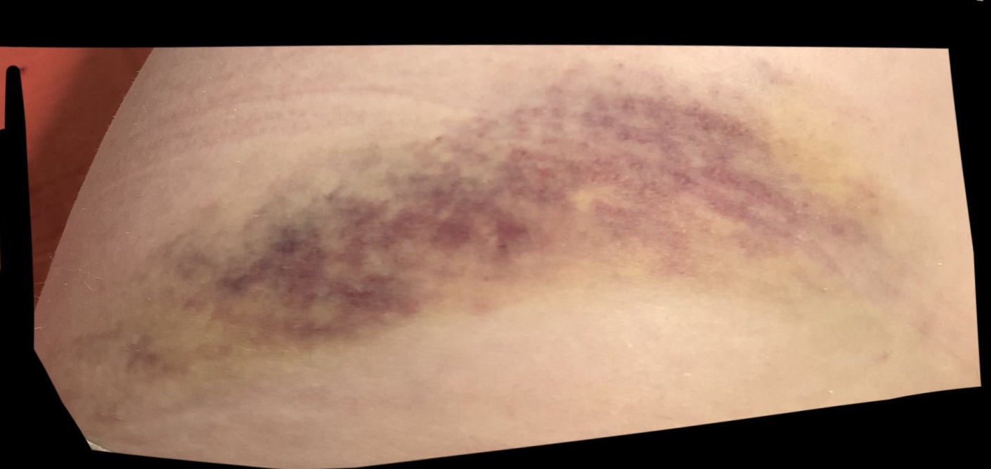 The bruise on my left upper thigh/hip.