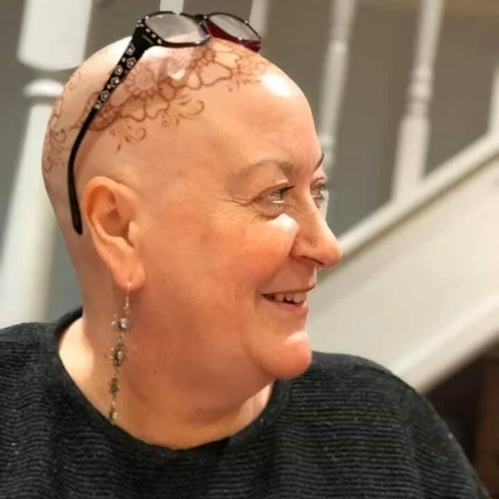 Hair Loss and Childlessness