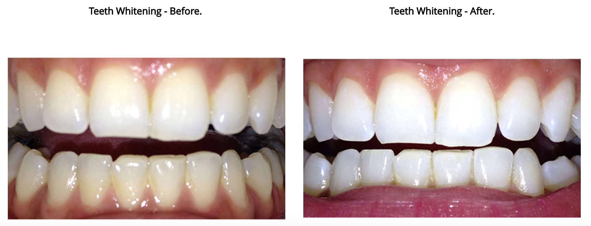 teeth white 2.png
