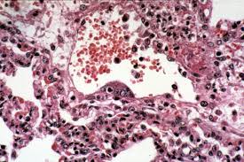 What is Nipah virus? Deadly brain-damaging virus spreads in India