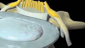 Discectomy — Spine Together