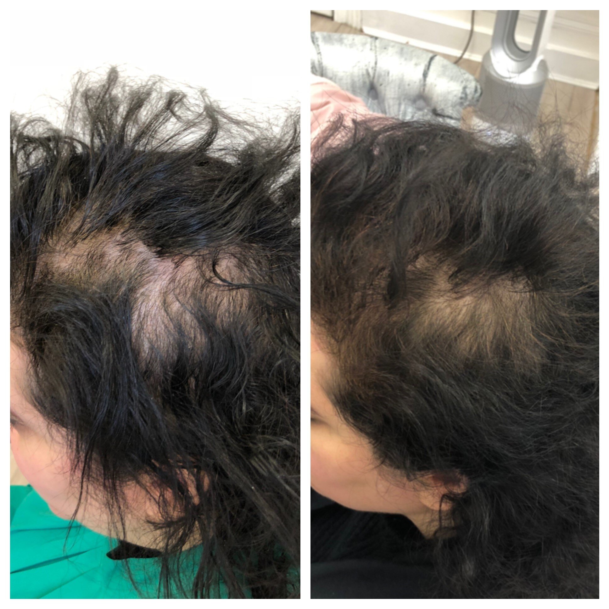 38 y/o Female PRP Hair Regrowth Treatment Results · Bauman Medical