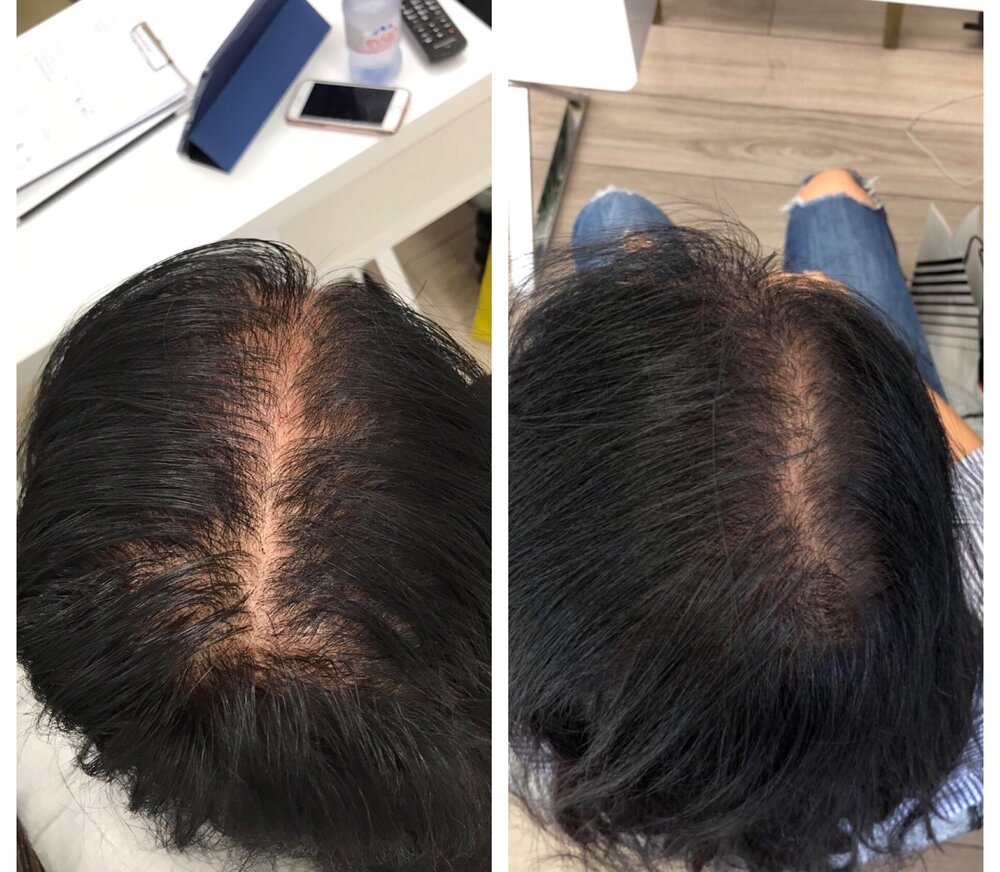 PRP Hair Treatments In London | See Our Before & Afters — The PRP Lab.
