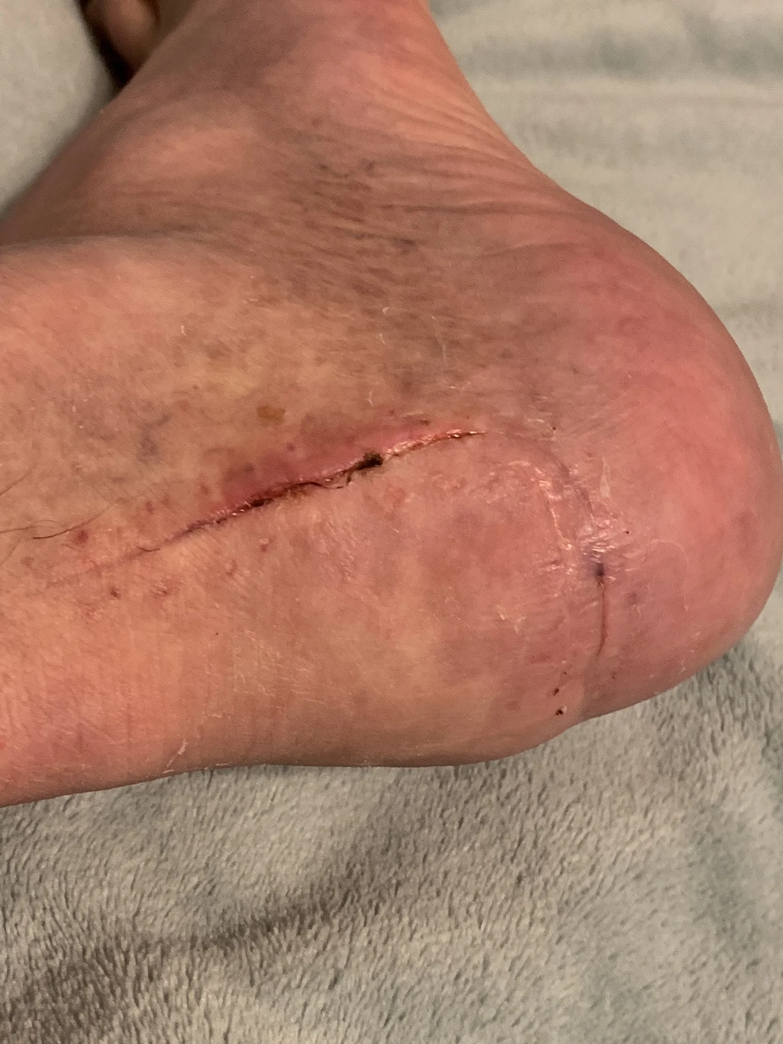 Heel incision progress
