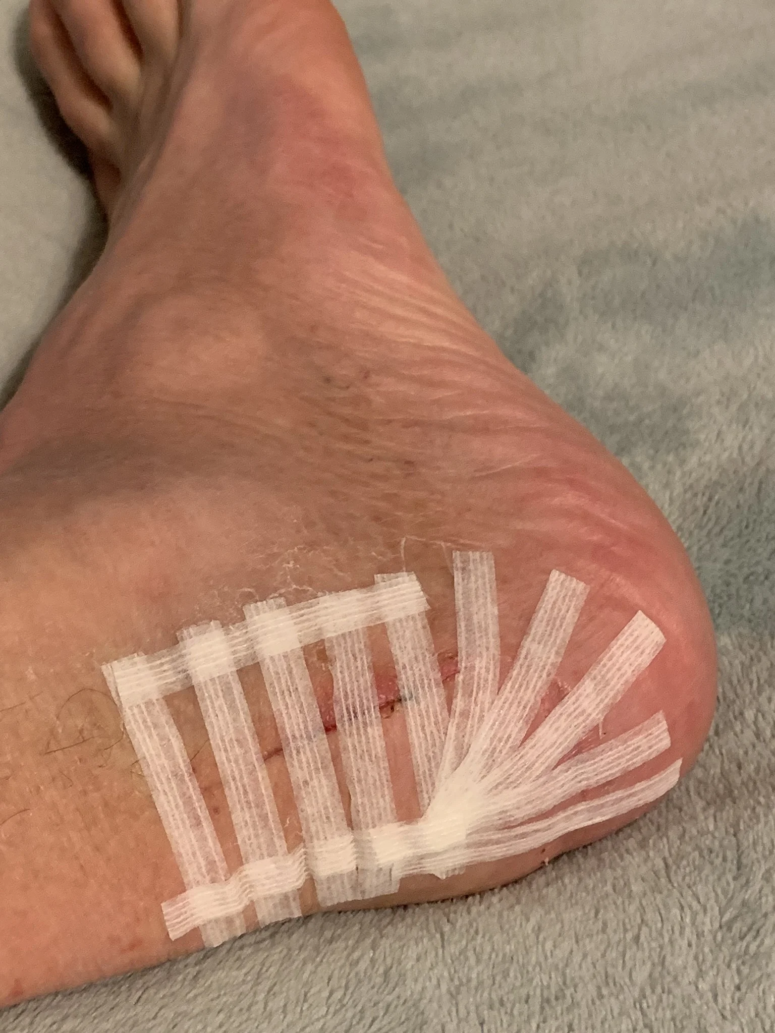 Heel incision with strips applied and tacked