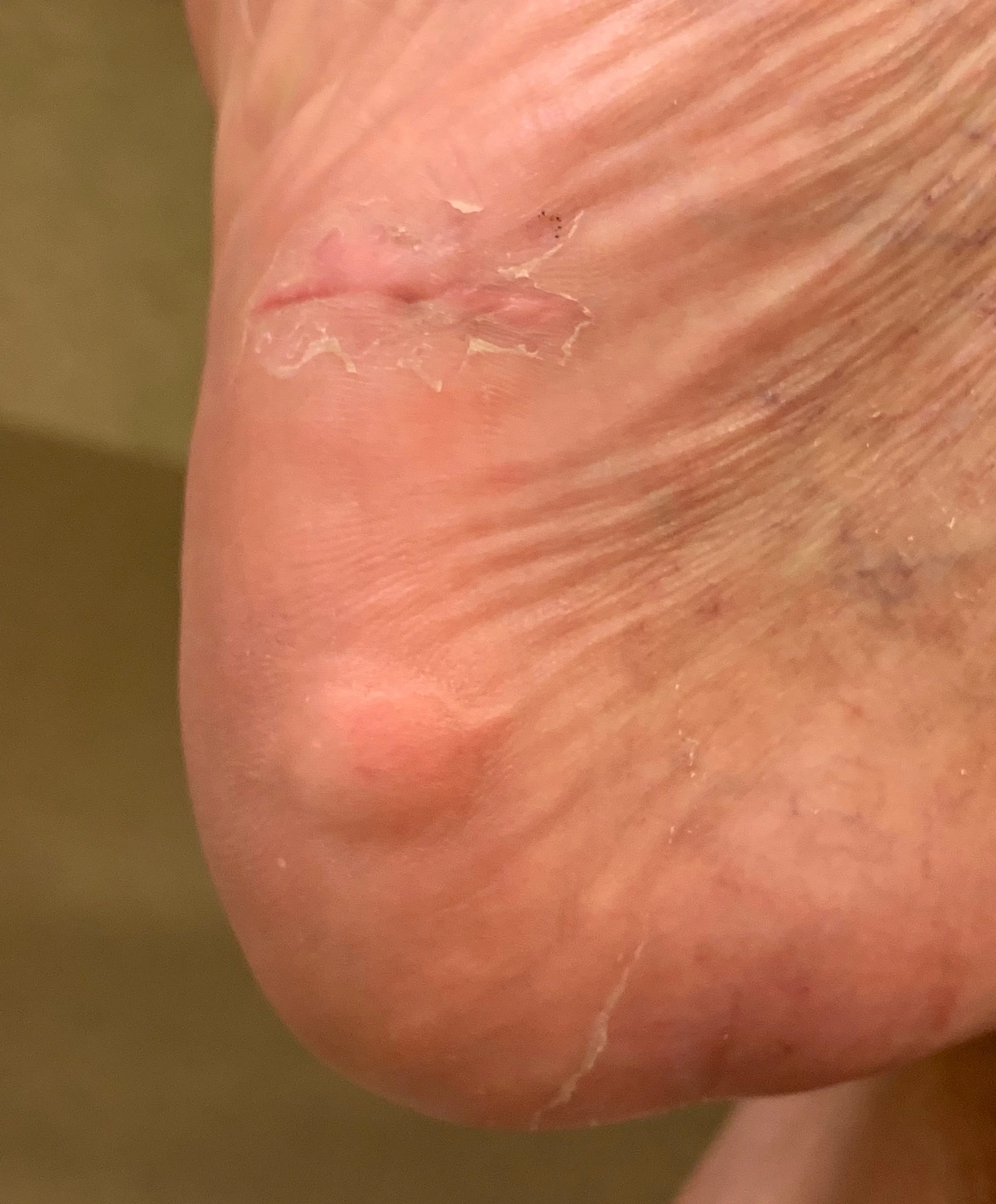 Healing progress: foot bottom