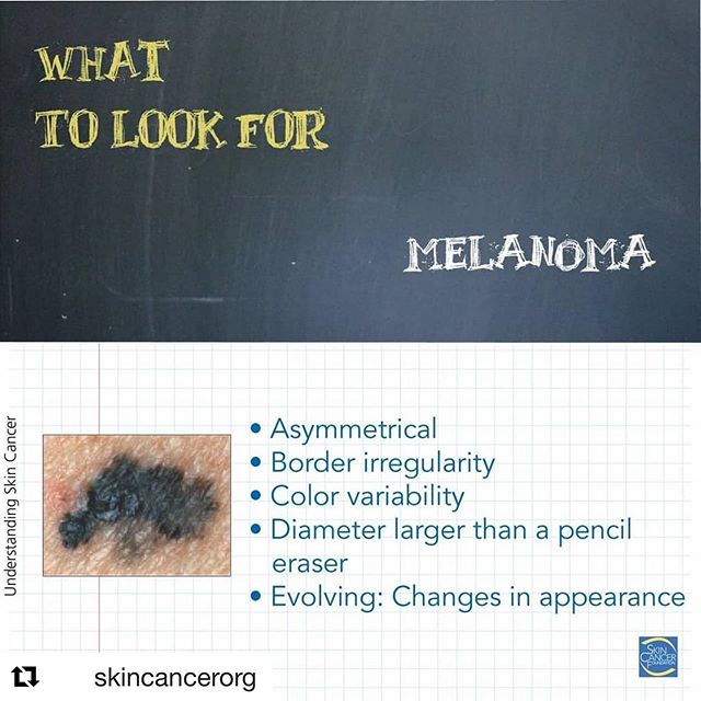 Studies have shown that exposure to ultraviolet (UV) radiation from the sun increases your risk of getting melanoma, especially if you had sunburns during childhood. ☀️ ☀️ Melanoma is an aggressive skin cancer that often resists drug treatment. It arises when pigment-producing skin cells, called melanocytes, become cancerous. ☀️☀️ The rates of melanoma have been rising for the last 30 years. In fact, between 2009 and 2019 the number of new invasive melanoma cases diagnosed annually increased by 54 percent. (Source: Skin Cancer Foundation - skincancer.org and American Cancer Society - cancer.org)
☀️☀️ If conventional chemical sunscreen actually worked, then why have the rates of melanoma jumped by 54% in the last 10 years!!! The truth is that they don’t work. Unlike zinc oxide, they do not adequately protect against UVA rays and they degrade when exposed to UV light. The very chemicals that are supposed to be protecting us from UV light break down when exposed to it releasing free radicals that cause DNA damage. A terrible irony and a recipe for cancer. ☀️☀️ ・・・
#skincancer101
#melanoma #scc #bcc #ak #skincancerprevention #skincare #broadspectrum #safesunscreen #skincancer #skincancerawareness #skincancerawarenessmonth #wearsunscreen #nosunburn
#Repost @skincancerorg with @get_repost