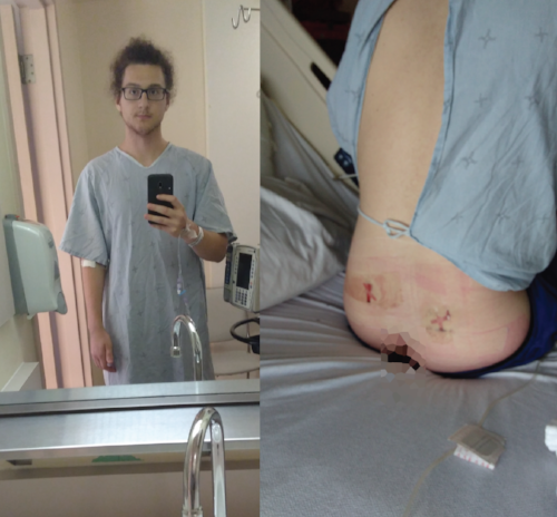 Me, following a stem cell donation in late 2016. I donated via a bone marrow harvest. The procedure was painless and recovery was quick. Most donations actually involve a non-surgical procedure where stem cell are taken from the peripheral blood.