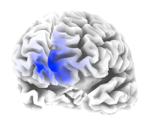 A 3-D model of brain function, showing the same areas of areas of deviance as above. These models allow precise localisation of problem areas in the brain.