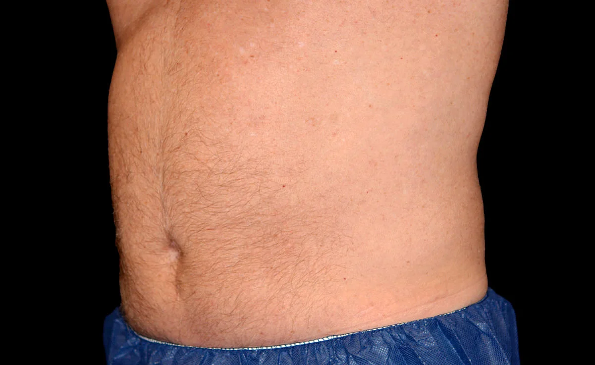 male-abdomen-after.jpg