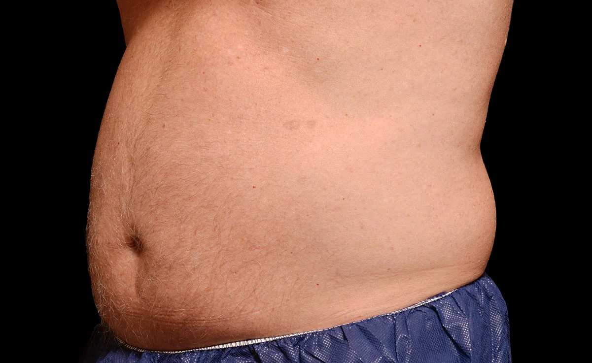 male-abdomen-before.jpg