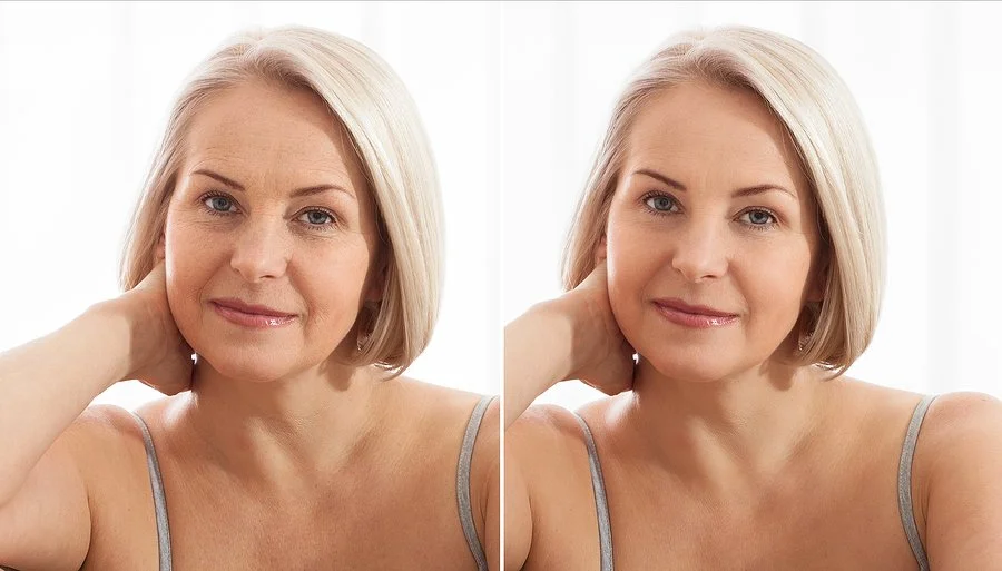 Recovering From a Face-Lift? Here's What to Expect and How to Heal at Home