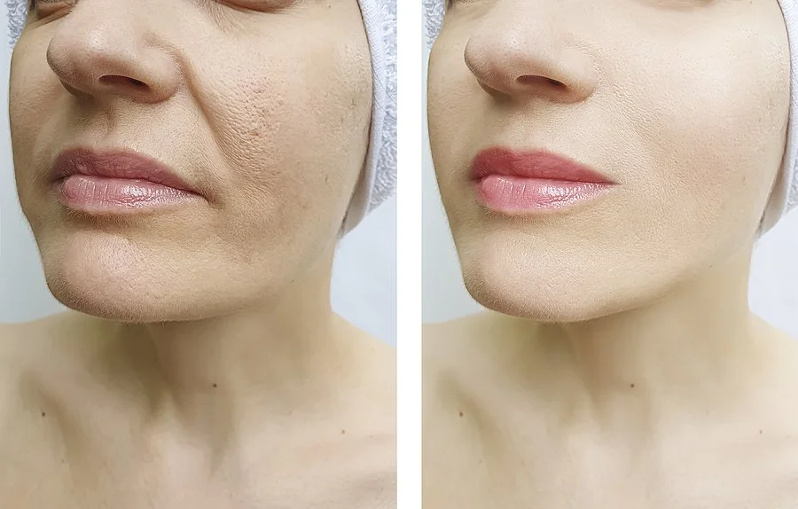 The First Month of Facelift Recovery: What to Expect