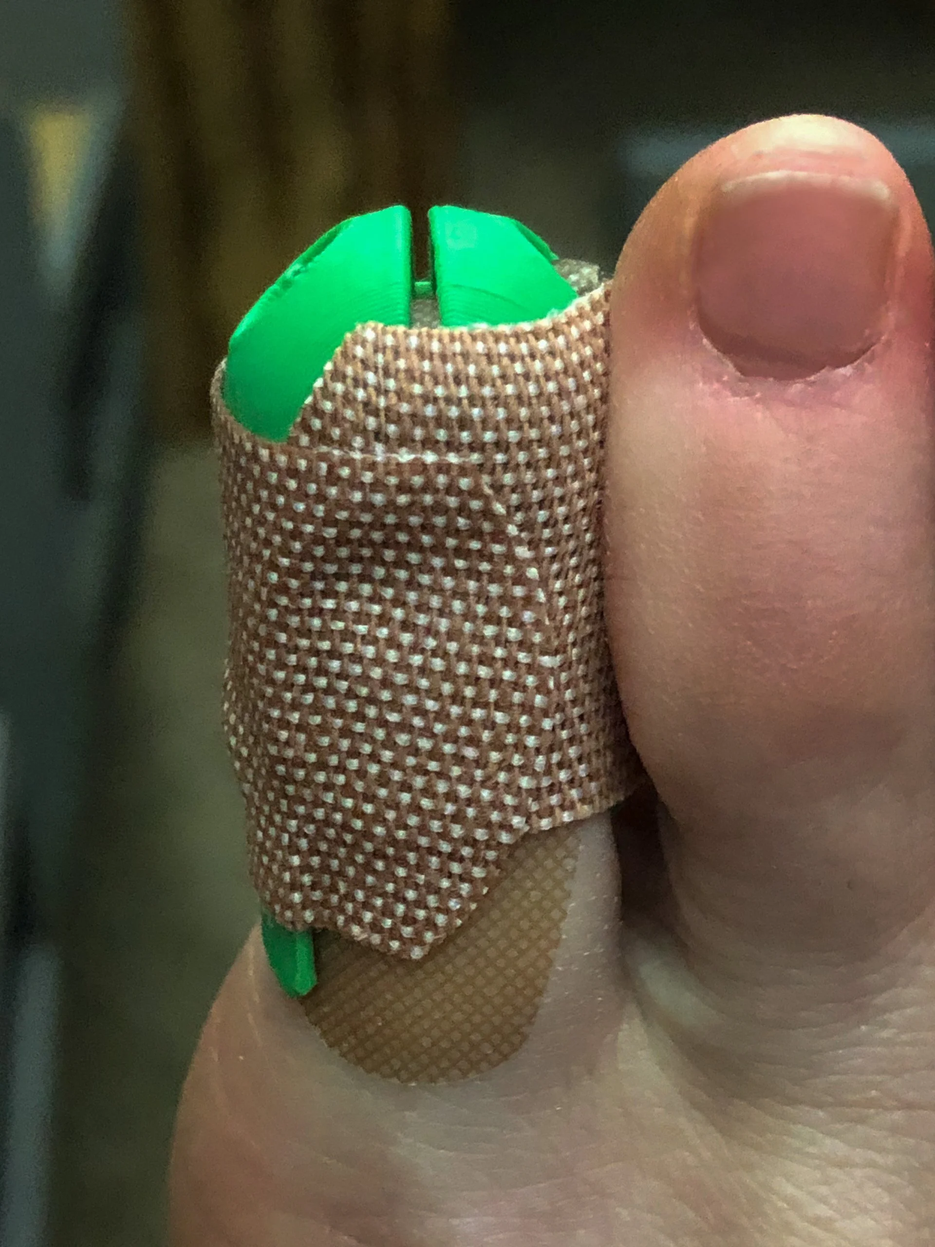 toe_splint_03.jpg