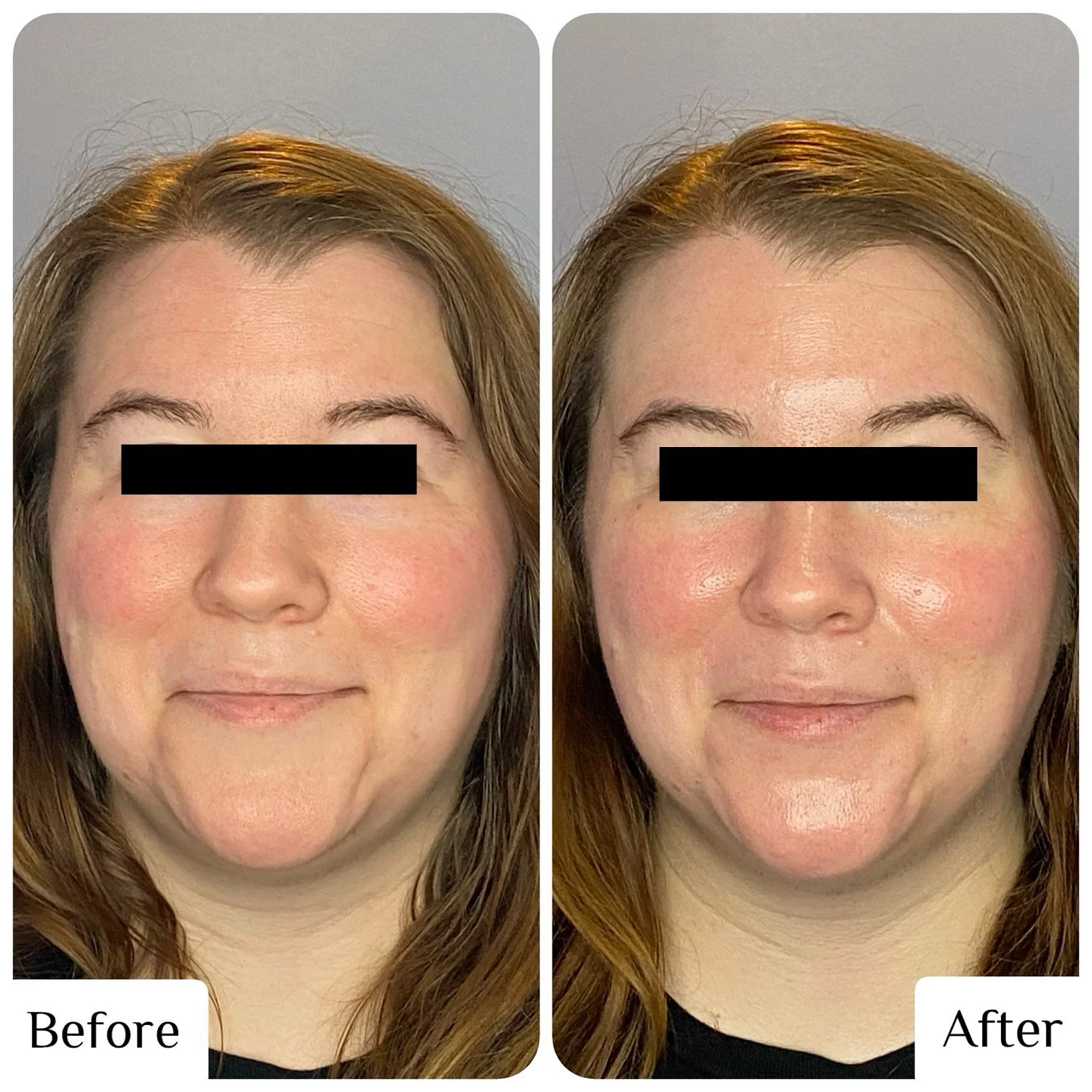 Before and After: Microdermabrasion w/ Oxygen Infusion
