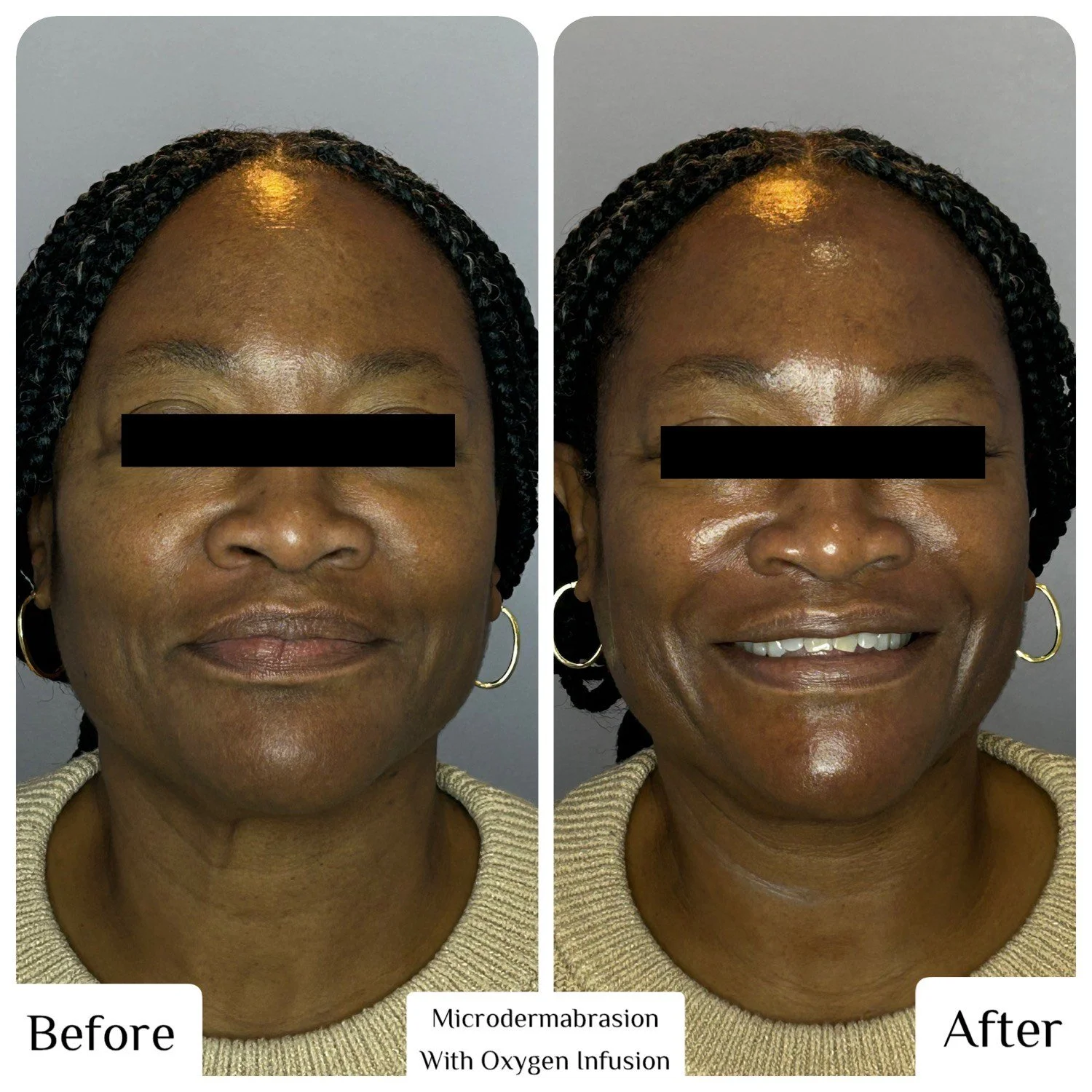 Before and After: Microdermabrasion w/ Oxygen Infusion
