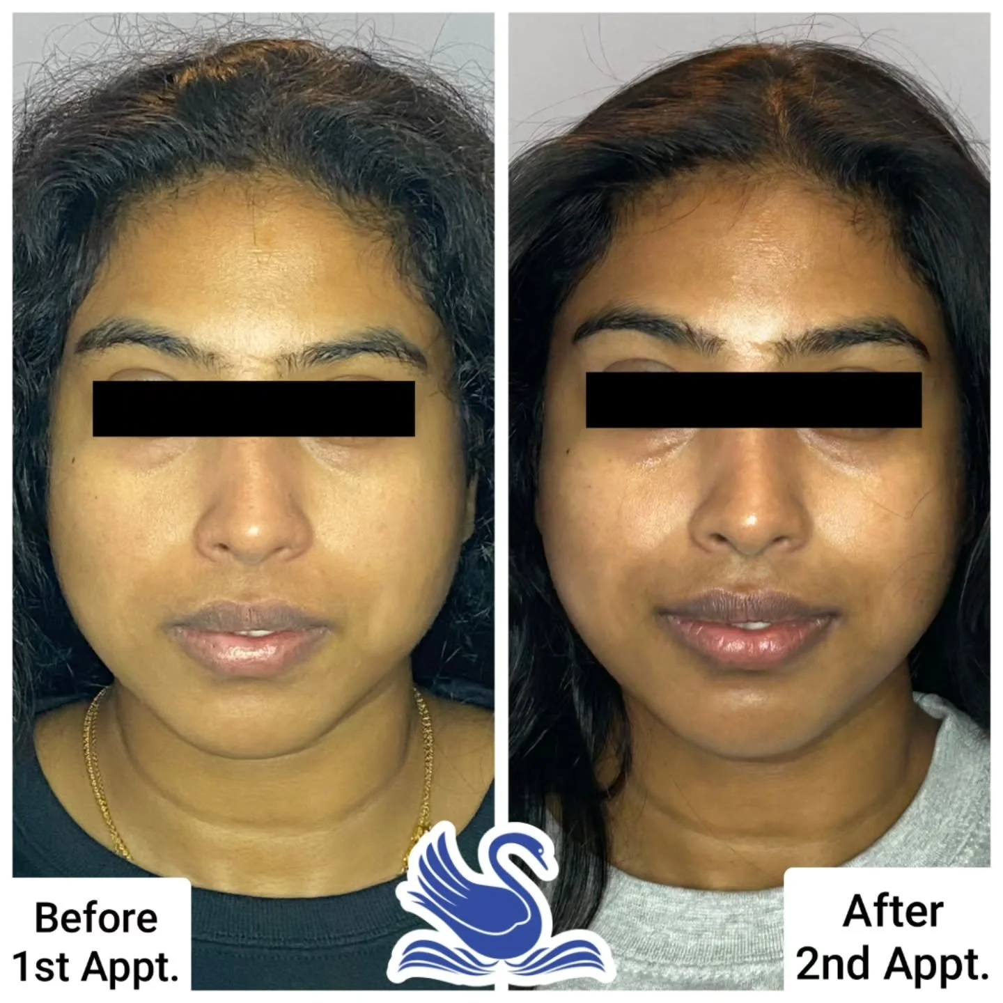 ✨️ One-Month Transformation ✨️
Look at the difference from this client's first visit on September 10th and her second visit on October 9th!

✅️ Improved Skin Texture
✅️ Evened Complexion
✅️ Increased Hydration

Significantly improve your skin's overa