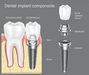 What to Expect With Dental Implants