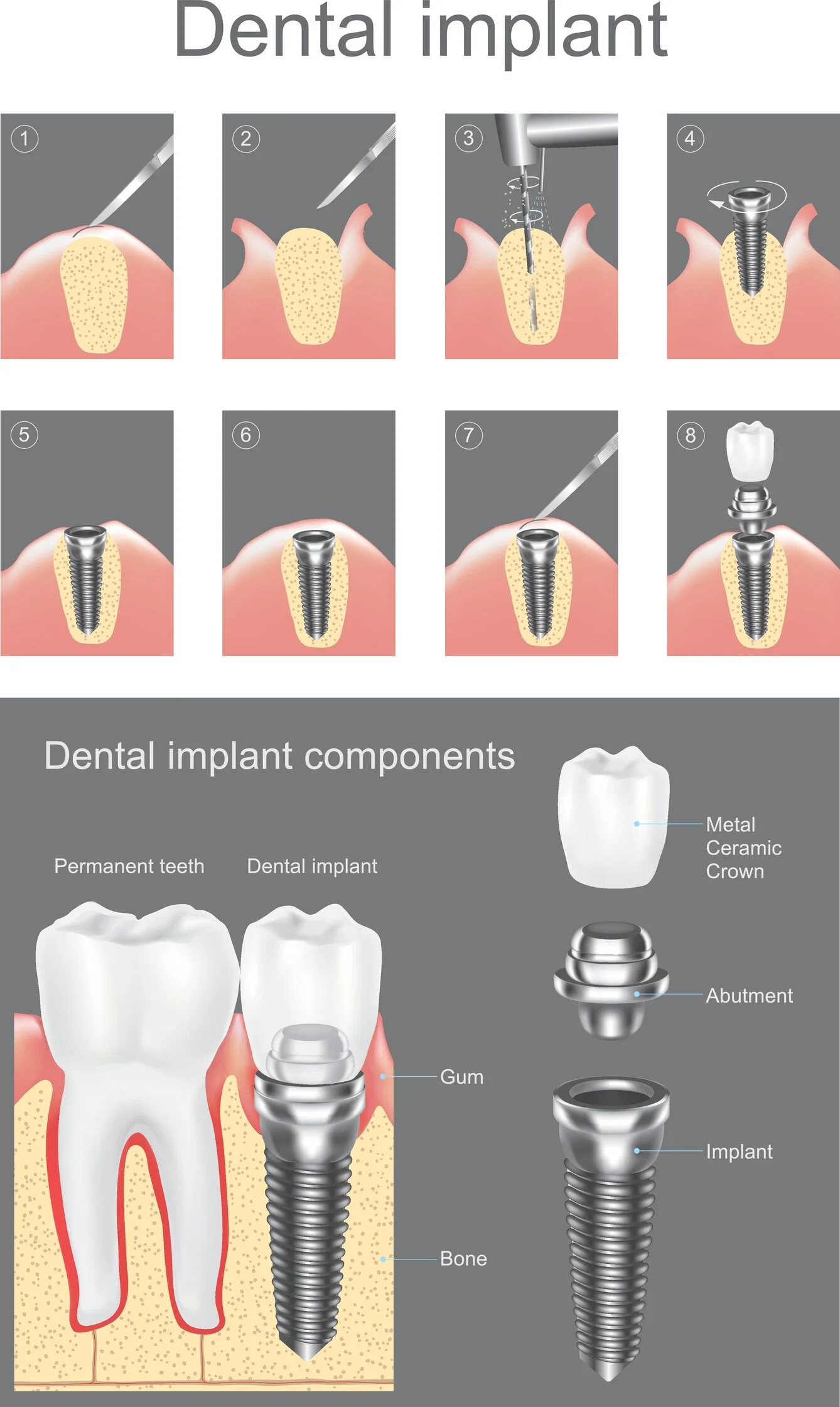 What Are Dental Implants and Are They Right For You
