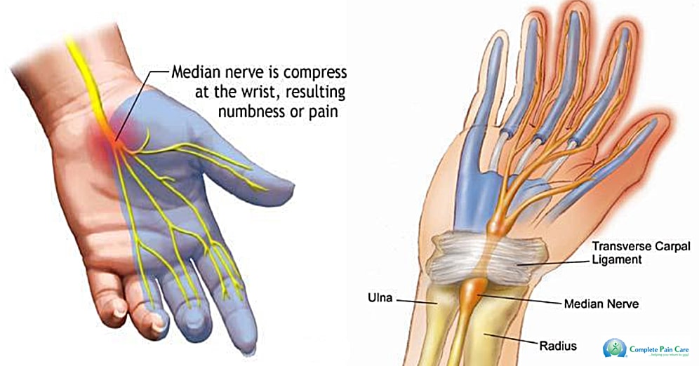 Image credit: https://www.completepaincare.com/patient-education/conditions-treated/carpal-tunnel-syndrome-cts/