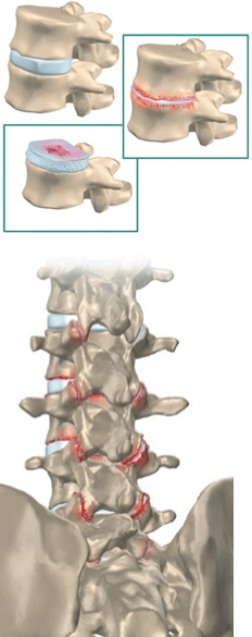 Cum se tratează spondiloza și artroza coloanei vertebrale - barbering.ro