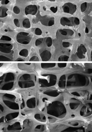 Osteoporose