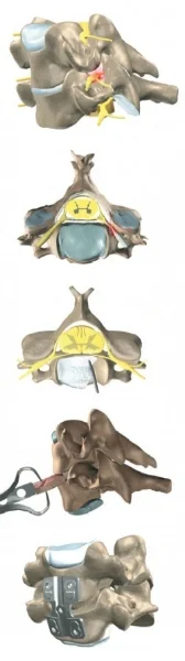 atrodese de coluna cervical.jpg