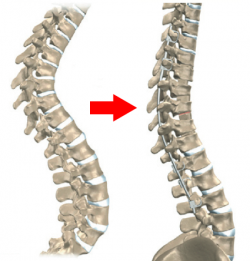 Artroplastia: Prótese de Disco