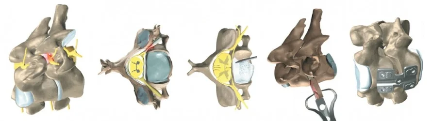 atrodese de coluna cervical.jpg