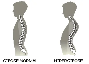 cifose normal e hipercifose.jpg