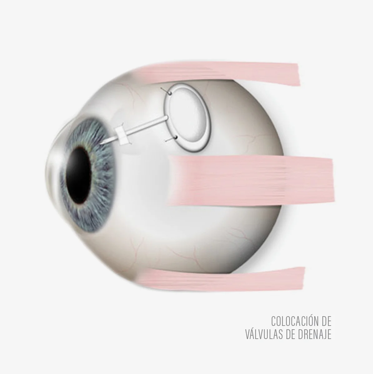 Glaucoma_implantWb.jpg