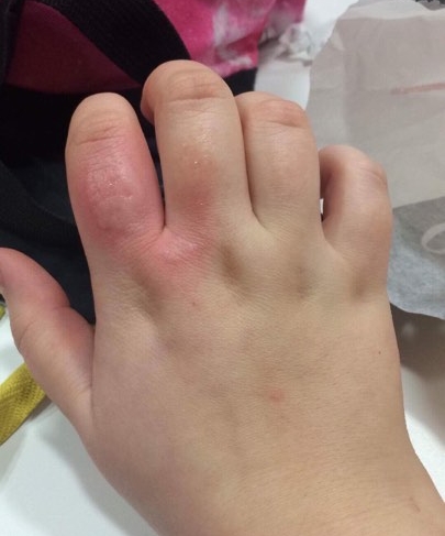 A burn from working on the meat grill without adequate protective gloves. January 2018