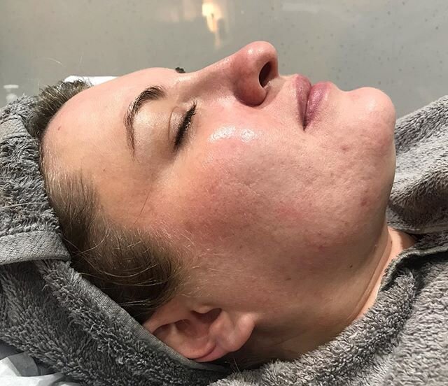 Results after just 1 @alumiermduk Radiance Peel!! ✨
.
.
Our skin peels treat a wide range of skin issues including ageing, pigmentation, acne and rosacea for more info or to book a consultation just get in touch! 💖