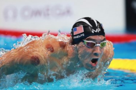 Ο Μichael Phelps με σημάδια από βεντούζες
