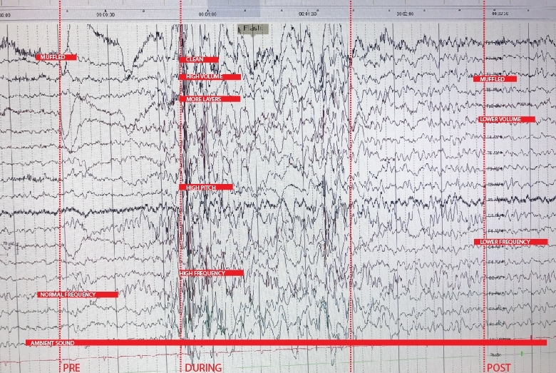 We mapped the Before seizure tendencies, During seizure brain waves and After seizure EEG pattern and assign sound qualities to it.