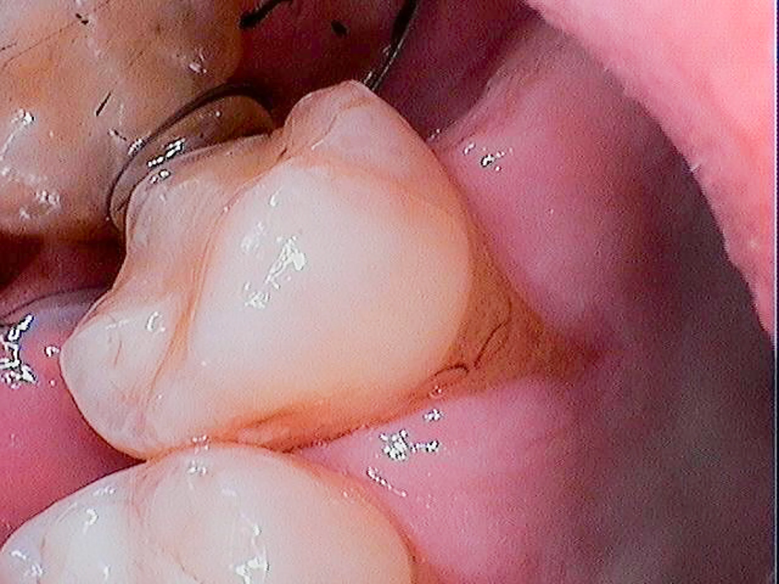 The discolored triangle at the base of this upper molar is gum loss caused by the brute force of my traditional palate expander