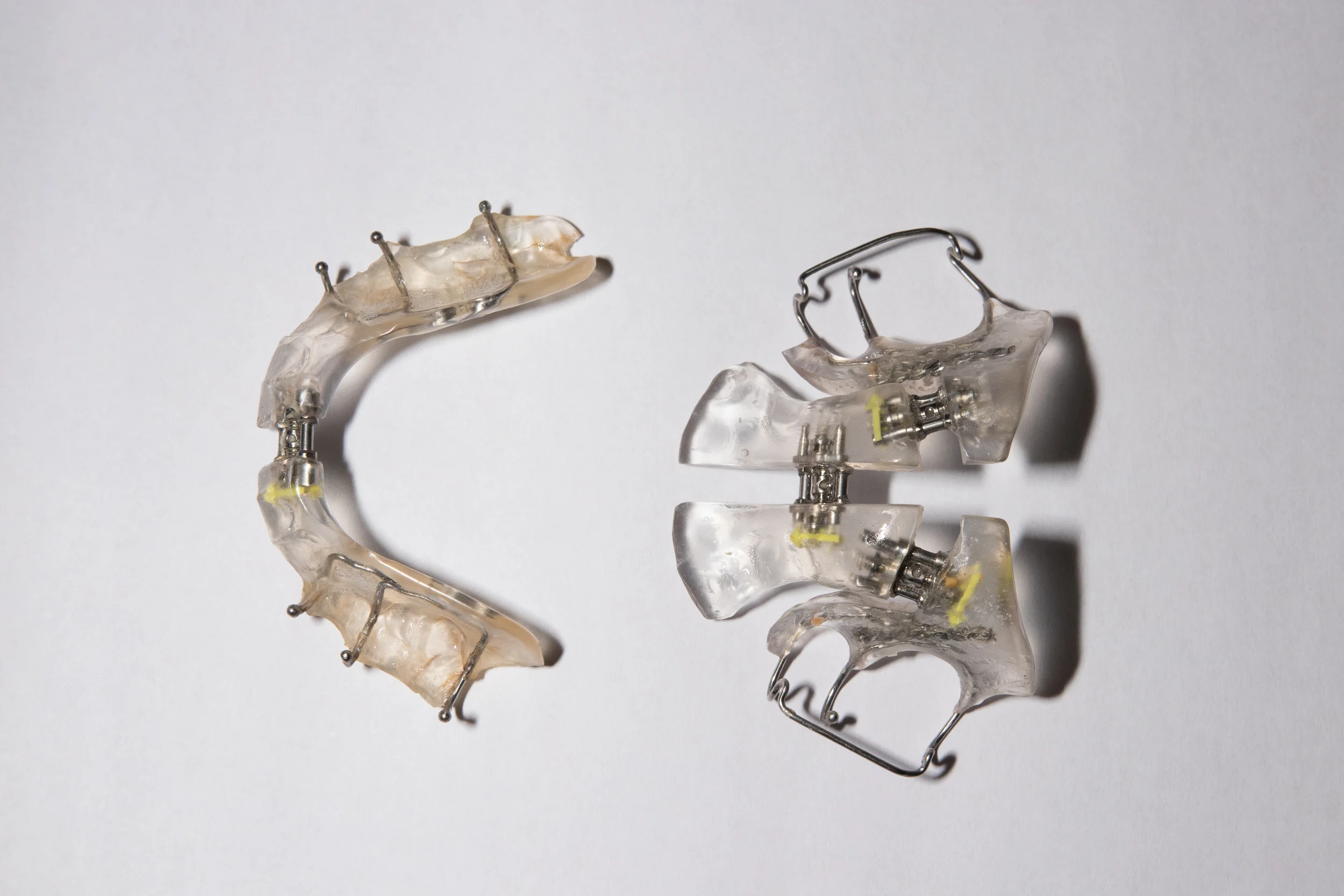 My upper and lower acrylic palate expanders, called sagittal appliances. These expanders failed.