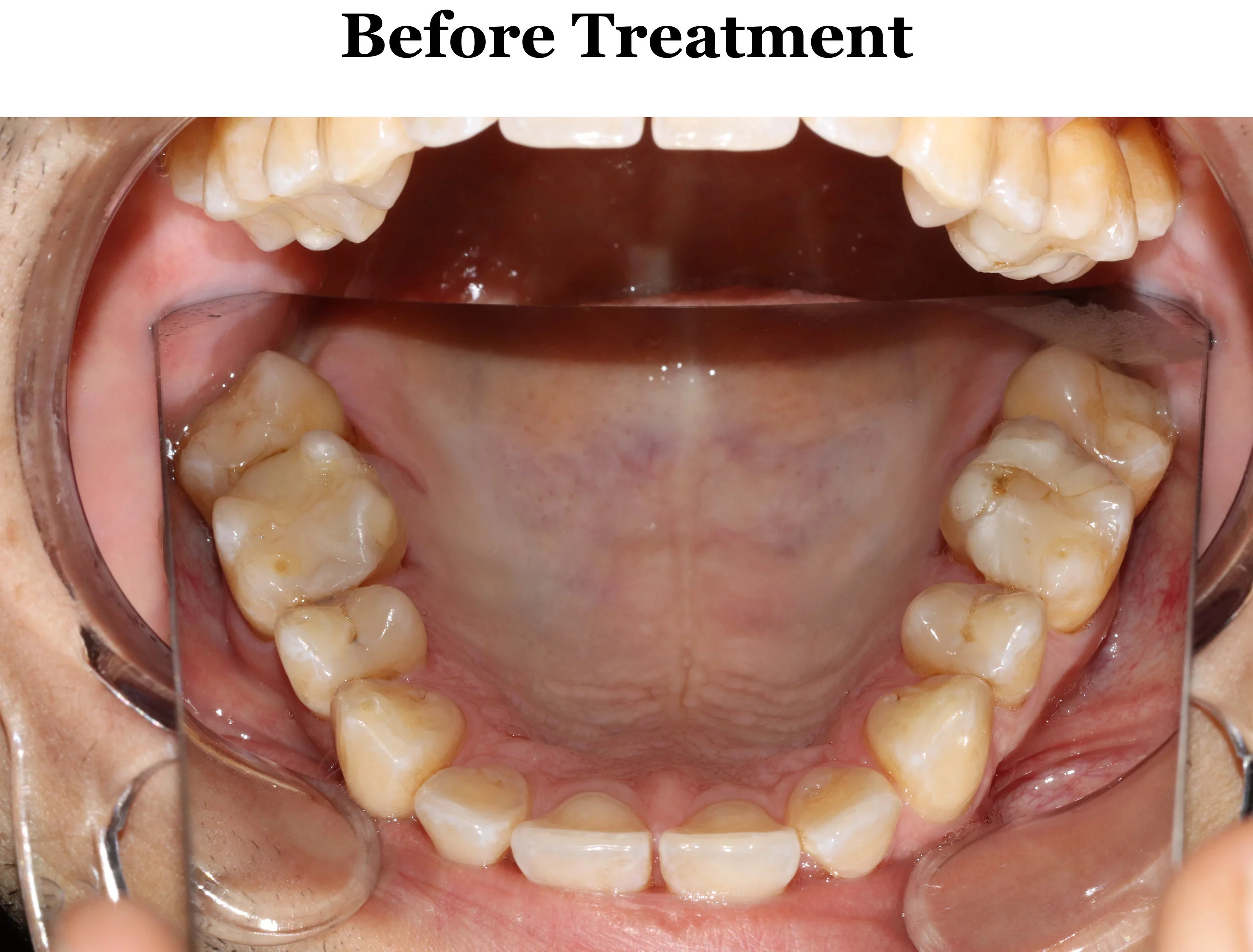 I Finally Figured Out Proper Tongue Posture — JAW HACKS