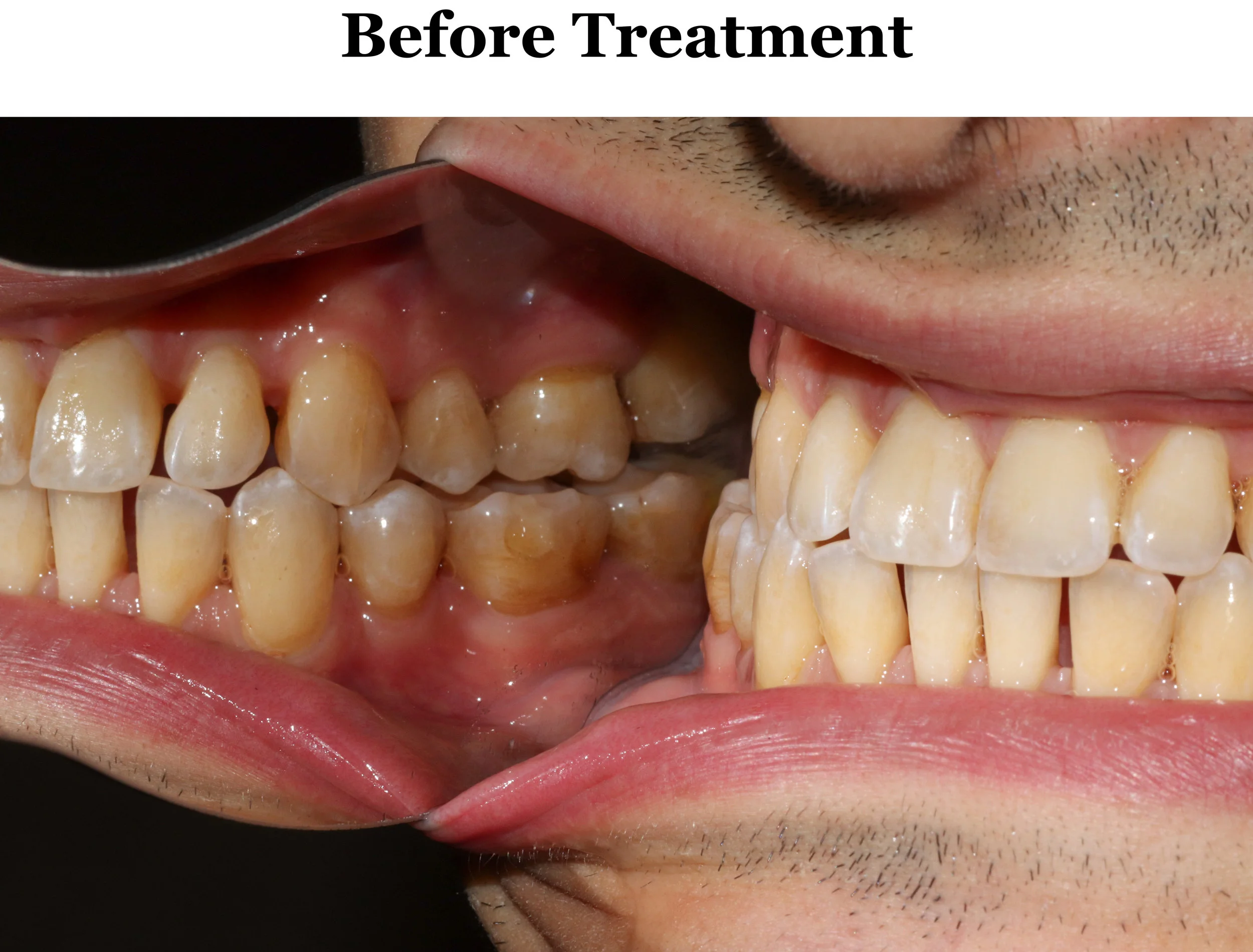 I Finally Figured Out Proper Tongue Posture — JAW HACKS