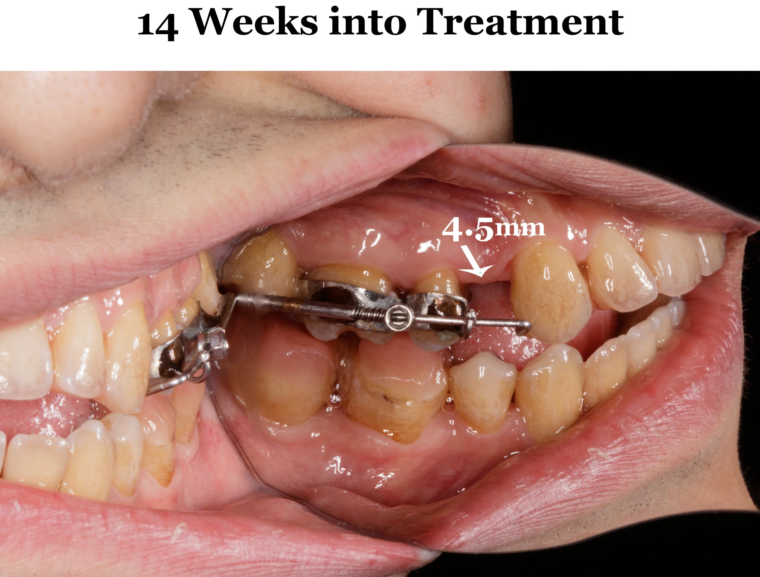 I Finally Figured Out Proper Tongue Posture — RONALD EAD
