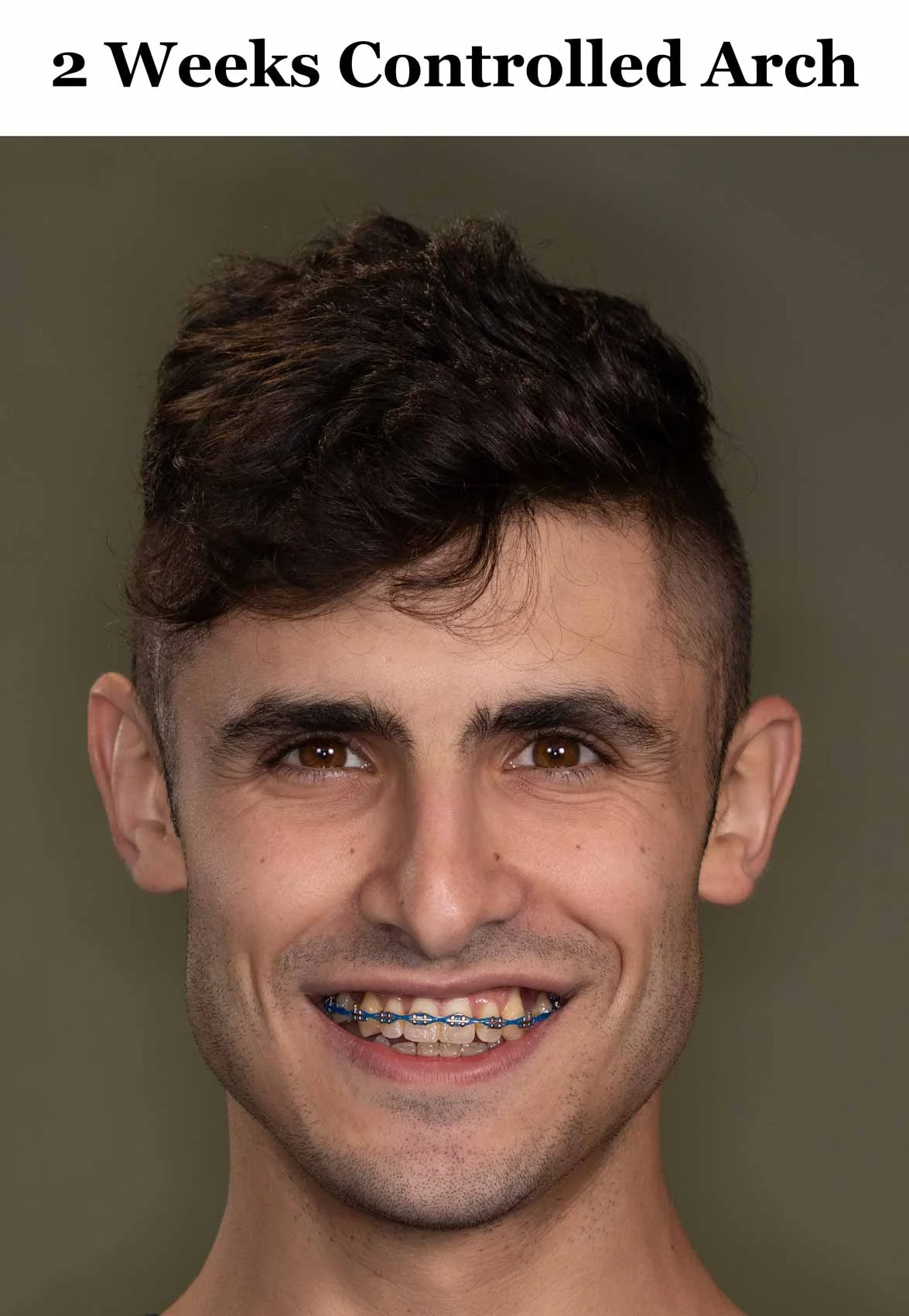 ca_2-weeks_frontal-smile.jpg