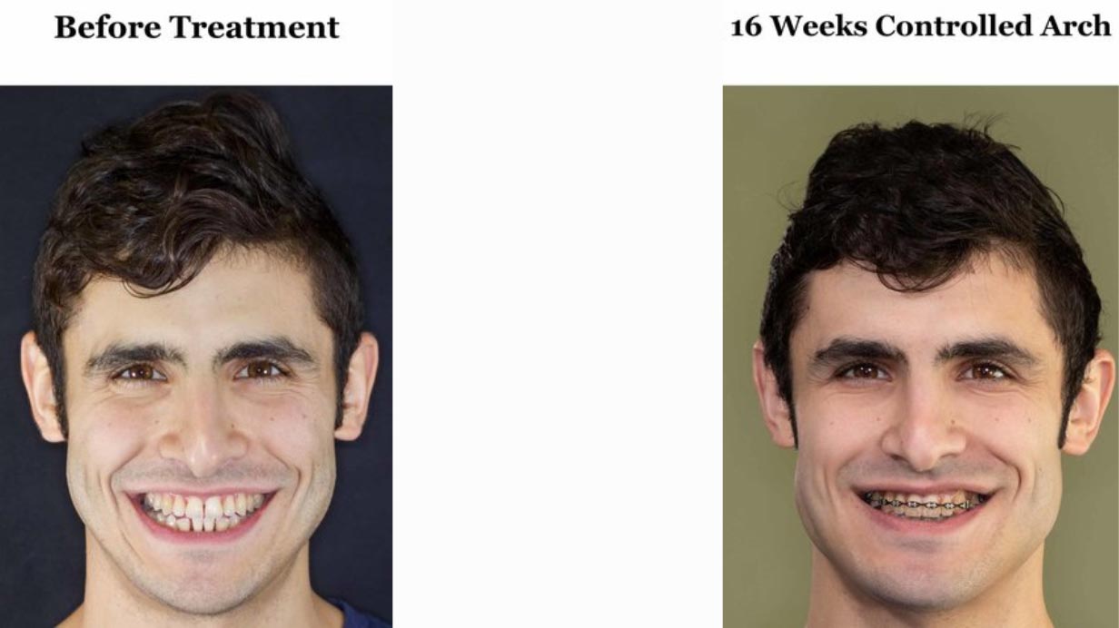 In my opinion I did not have a cant before treatment. But I certainly still do at this point, after 10 months of AGGA and almost 4 months of braces.