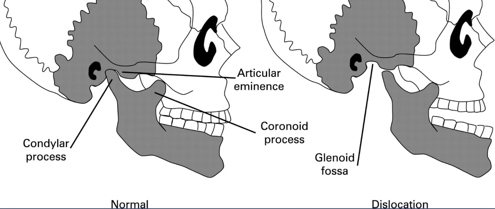 The left image shows normal condyle position in the TMJ. The right image shows a condyle that is dislocated forward. If you expand too far with AGGA you may end up dislocated forward in order to avoid a large overbite.