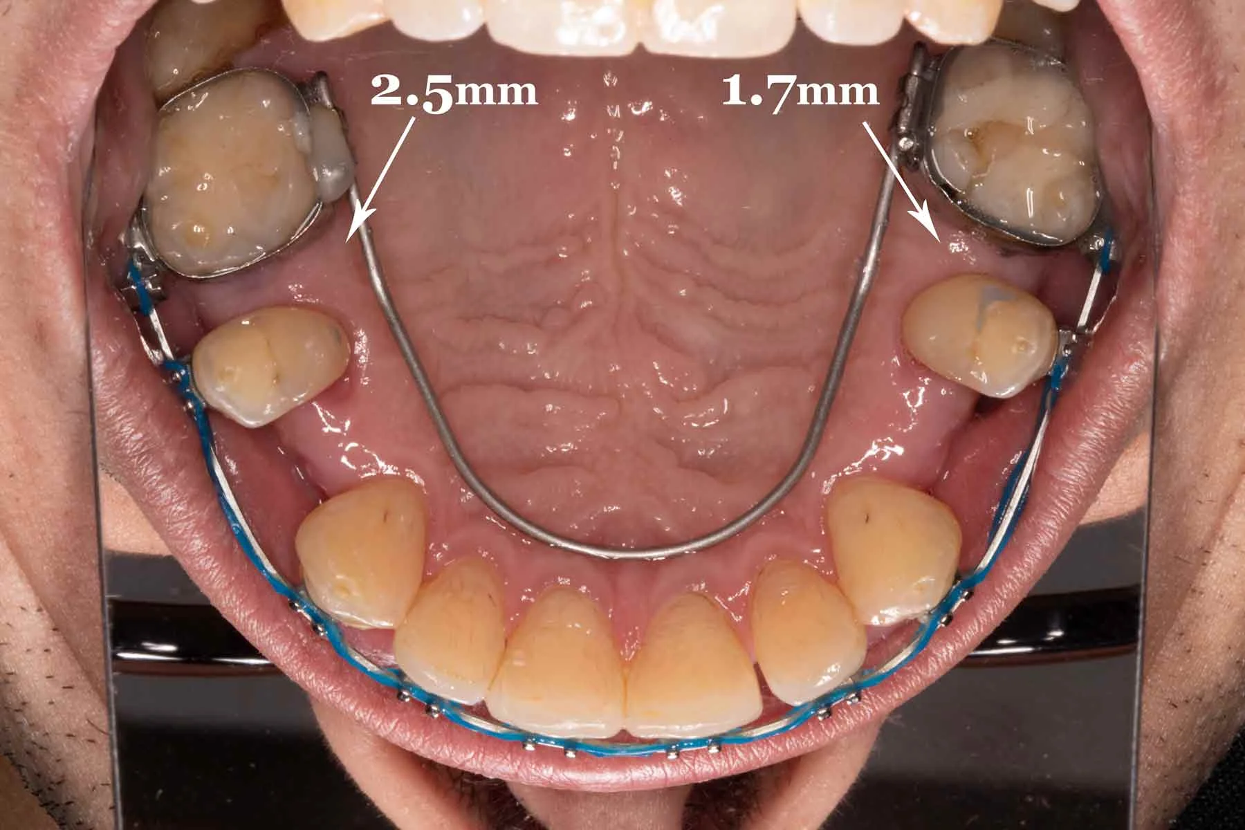 The Controlled Arch leverages the combined root strength of the front teeth to drag the back teeth forward to close the AGGA gaps. This can be problematic for patients whose front teeth have already been compromised by aggressive AGGA expansion, since using the front teeth for anchorage places additional stress on them.