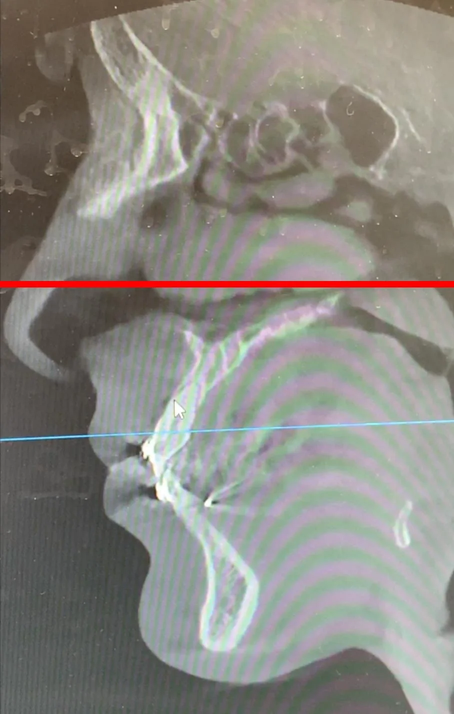 The red line serves as the x-axis, at 0 degrees. It puts the downward angulation of my maxilla into perspective. This x-ray was taken after AGGA treatment, in January 2019, which means AGGA did not upright my maxilla into a more neutral (0 degree) position.