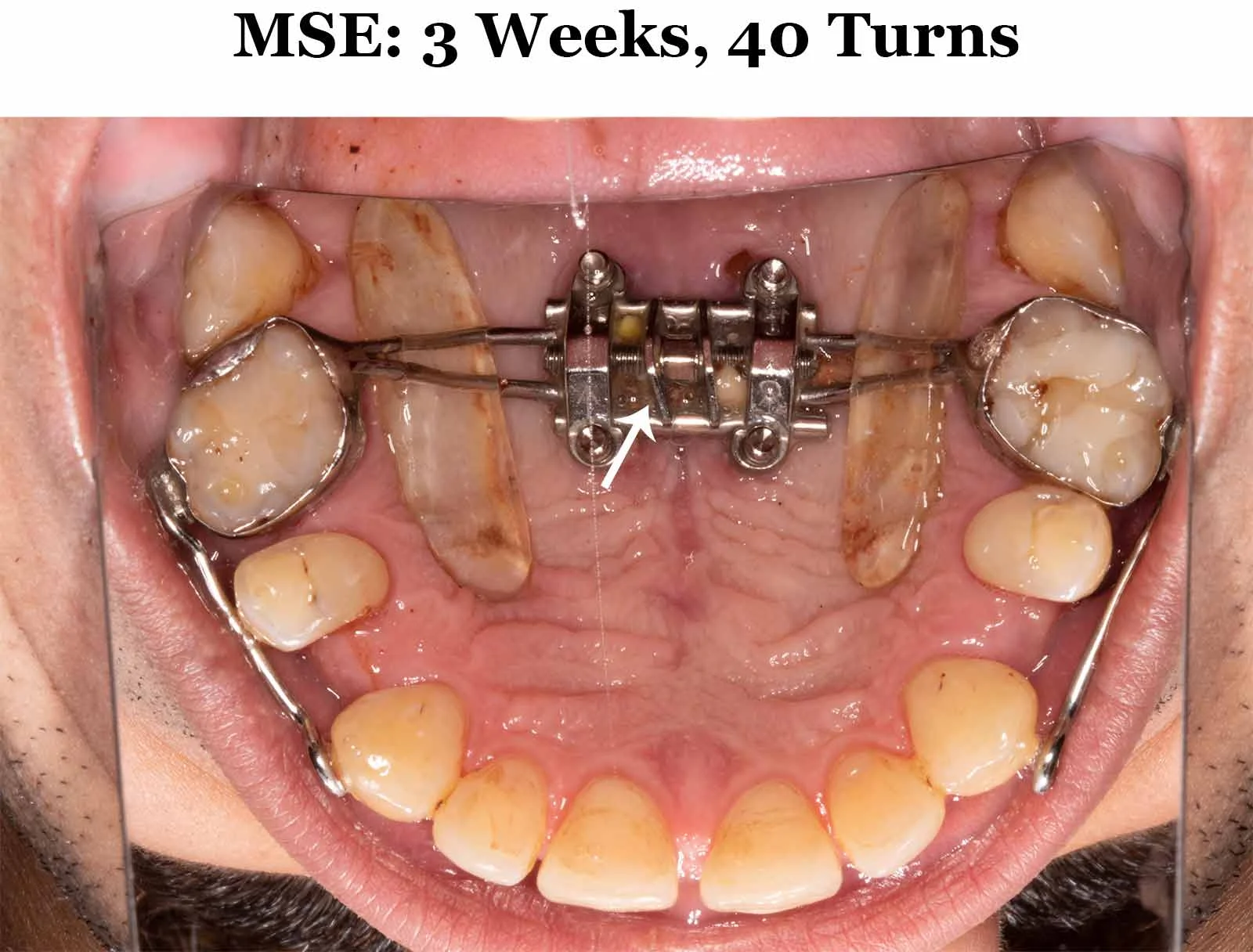 3 Weeks MSE_Upper.jpg